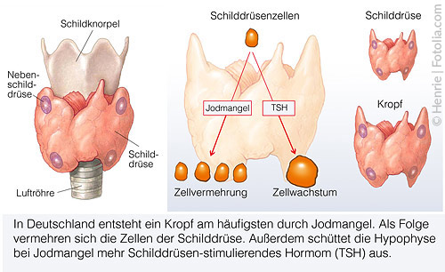 Durch Jodmangel entwickelt sich ein Kropf (Struma), was eine Vermehrung der Schilddrüsen-Zellen zur Folge hat.